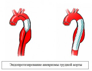 Аневризма грудної аорти: що характерно для захворювання