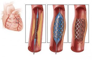 Стеноз легеневої артерії: що являє собою, і яка середня тривалість життя