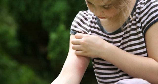 Укуси комарів у дітей: лікування, як визначити, наскільки небезпечні, як лікувати