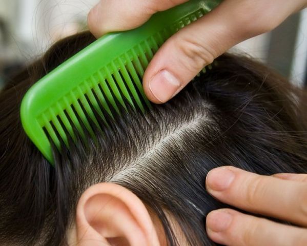Шампунь від вошей і гнид: як виглядають гниди на волоссі, як швидко вичесати, який вибрати шампунь