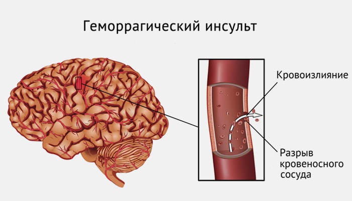 Геморагічний інсульт головного мозку: наслідки, лікування та прогноз