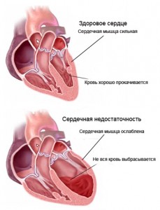 Гостра серцева недостатність – найчастіша причина смерті хворих із серцево судинними дисфункціями