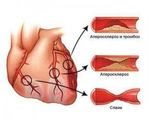 Атеросклероз аорти: що це таке і як лікувати захворювання