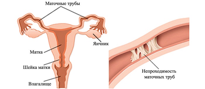 Ознаки непрохідності маткових труб, лапароскопія і інші методи діагностики