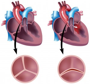 Двостулковий аортальний клапан – вроджений порок серця