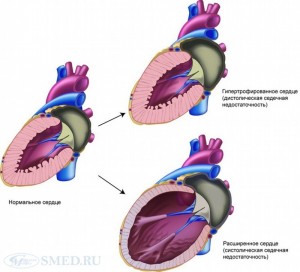 Декомпенсована серцева недостатність: які симптоми характерні