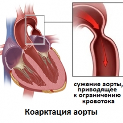 Коарктація аорти: симптоми і лікування патології