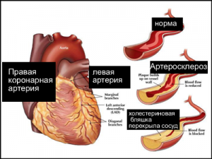 Кардіосклероз серця: симптоми та форми захворювання