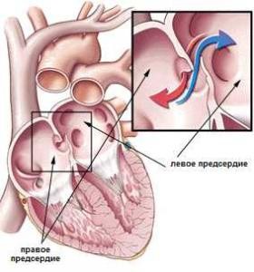 Додаткова хорда лівого шлуночка в серце – патологія або норма