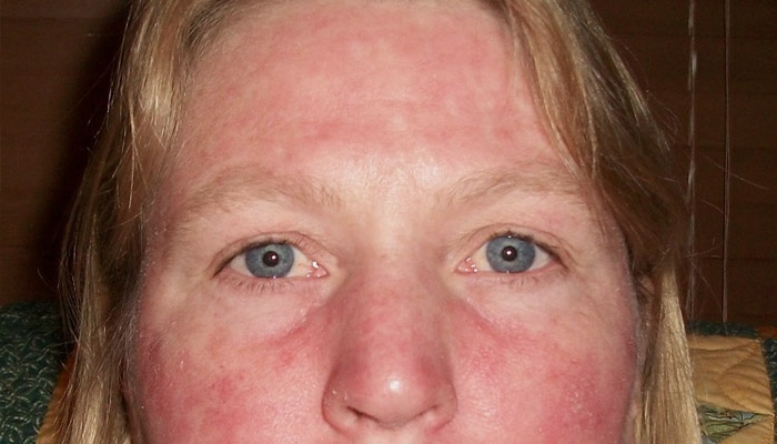 Гіперемія шкіри обличчя і тіла: причини, симптоми і лікування почервонінь