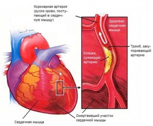 Обширний інфаркт – що це, основні симптоми і варіанти лікування