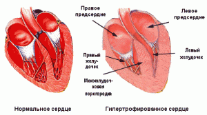 Стеноз легеневої артерії: що являє собою, і яка середня тривалість життя