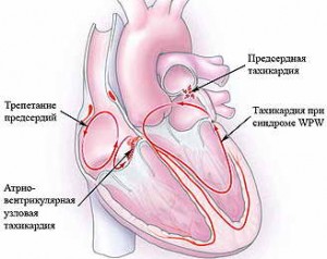 Найбільш часті причини та способи лікування прискореного серцебиття