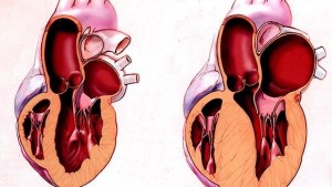 Рестриктивна кардіоміопатія: причини та особливості перебігу