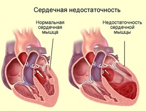Головні ознаки серцевої недостатності у жінок та фактори,що впливають на їх інтенсивність