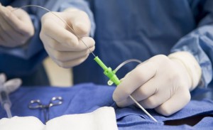 Ендоваскулярна хірургія – новий шанс на лікування миготливої аритмії