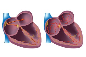 Основні причини та ознаки аритмії серця у жінок