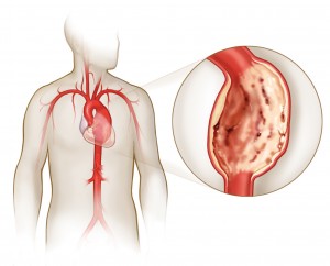 Розрив аорти серця: основні причини