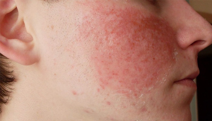 Гіперемія шкіри обличчя і тіла: причини, симптоми і лікування почервонінь