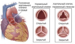Стеноз аортального клапана: симптоматика та особливості лікування