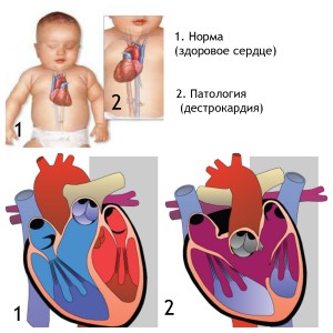 Що собою являє декстрокардія серця