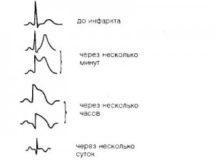 Як правильно розшифрувати кардіограму серця