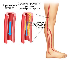 Облітеруючий атеросклероз судин нижніх кінцівок: симптоми і лікування хвороби