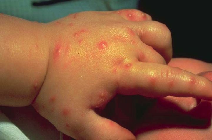 Алергія на укуси клопів: причини виникнення, групи ризику, види реакцій, екстрені заходи, наслідки, профілактика, відео