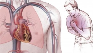 Лікування та профілактика стенокардії серця: основні використовувані препарати