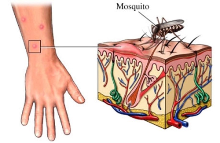Кошти від укусів комах: симптоматика, народні засоби від укусів, покупні засоби, думка фахівців, відео