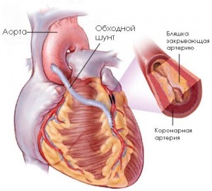 Аневризма серця   основні показники захворювання