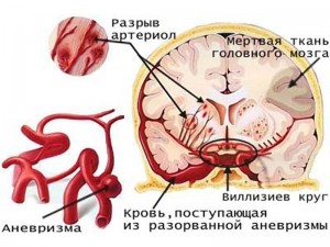 Аневризма судин головного мозку   чим вона небезпечна?