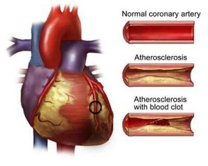 Шунтування судин серця та судин нижніх коненостей: яка вартість лікування та відгуки