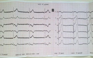 Що позначається на стрічці ЕКГ при інфаркті міокарда залежно від його класифікації