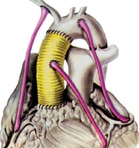 Коронарне шунтування судин серця: що це таке і скільки триває операція