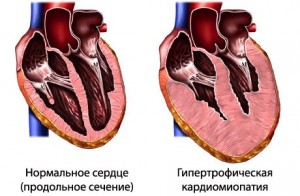 Гіпертрофічна кардіоміопатія: симптоми захворювання і принципи лікування