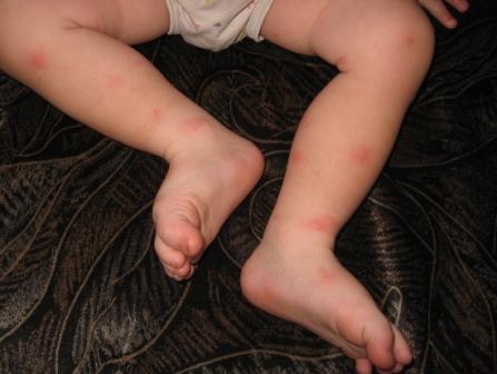 Укуси комарів у дітей: лікування, як визначити, наскільки небезпечні, як лікувати
