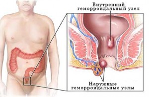Тромбоз гемороїдального вузла: етіологія та методи терапії