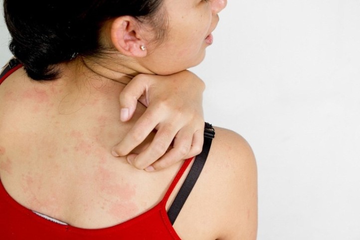 Алергія на укуси бліх: зовнішні та внутрішні ознаки, екстрені заходи, правила лікування, заходи захисту, фото