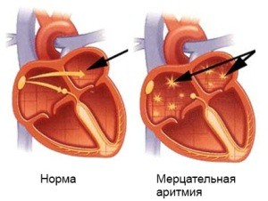 Причини виникнення різних видів аритмій серця