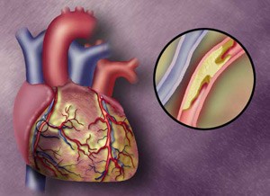 Атеросклеротичний кардіосклероз: клінічна картина захворювання і принципи лікування