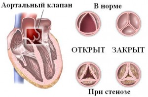 Симптоми і лікування стенозу аортального клапана