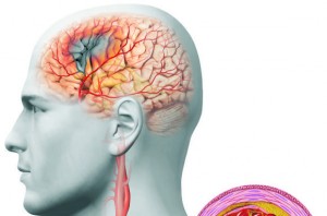 Звуження судин головного мозку: лікування, симптоми та причини виникнення недуги