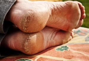 Тріщини на пятах – причини і лікування в домашніх умовах