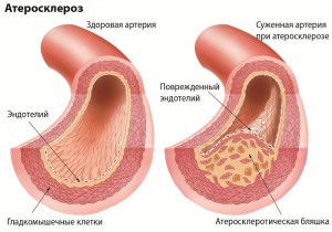 Коронарне шунтування судин серця: що це таке і скільки триває операція
