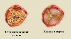 Серцева астма: характерні симптоми і принципи