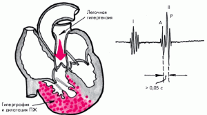 Легеневе серце: одна з ключових патологій серцевої діяльності