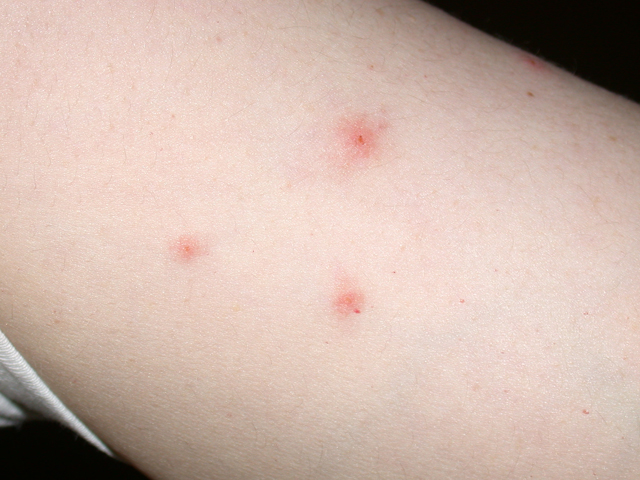 Як виглядають укуси бліх: зовнішні ознаки, інша симптоматика, наслідки укусів, екстрені заходи, фото