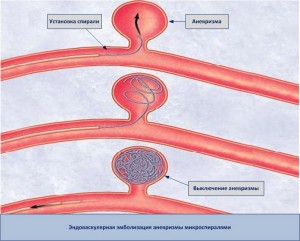 Аневризма сонної артерії: симптоми і небезпечне захворювання