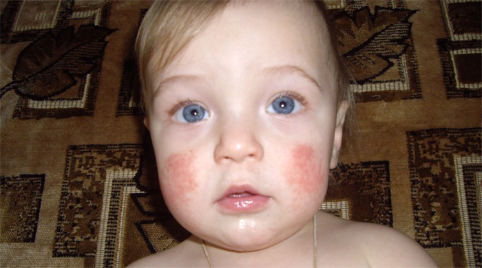 Псоріаз у дітей: симптоми початкової стадії, причини і лікування